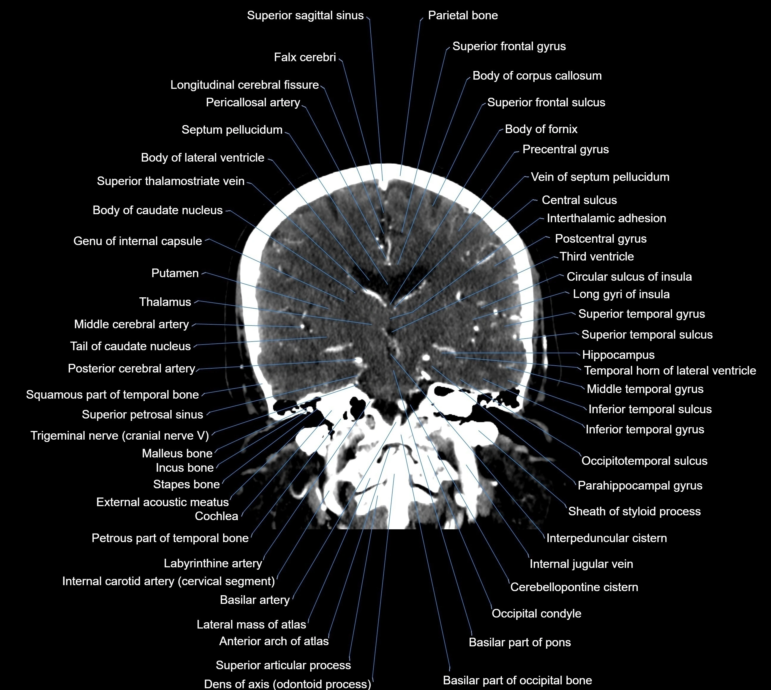 CT Brain coronal cross sectional radiology anatomy image  -img-00001-025.webp